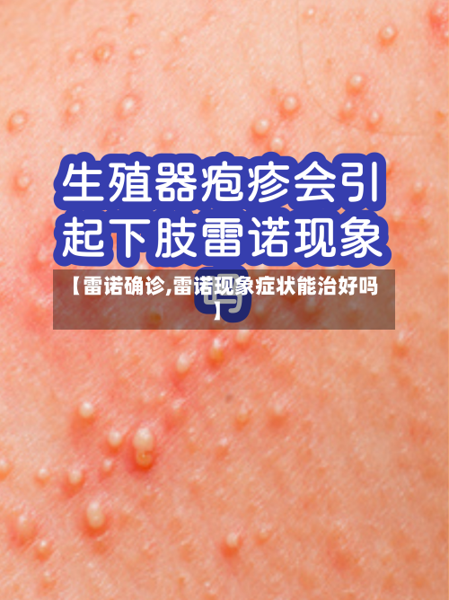 【雷诺确诊,雷诺现象症状能治好吗】