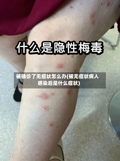 被确诊了无症状怎么办(被无症状病人感染后是什么症状)-第2张图片