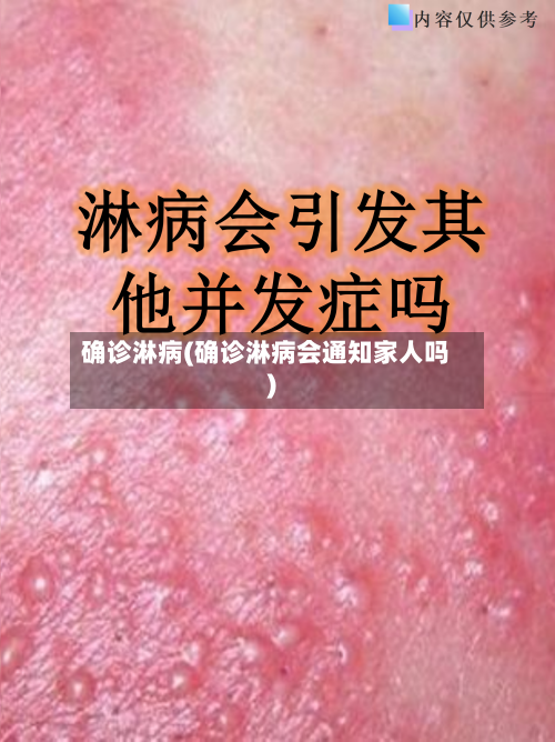 确诊淋病(确诊淋病会通知家人吗)
