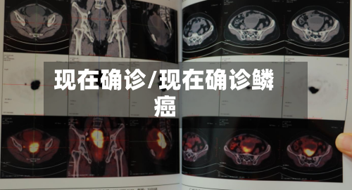 现在确诊/现在确诊鳞癌