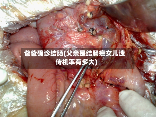 爸爸确诊结肠(父亲是结肠癌女儿遗传机率有多大)
