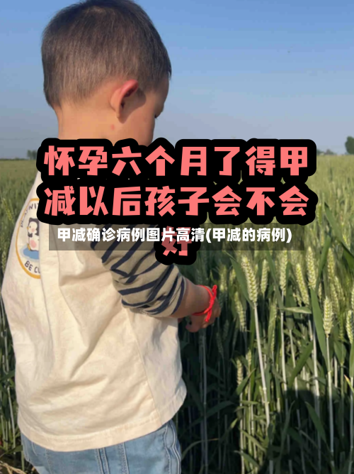 甲减确诊病例图片高清(甲减的病例)-第3张图片