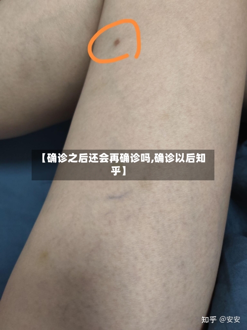 【确诊之后还会再确诊吗,确诊以后知乎】