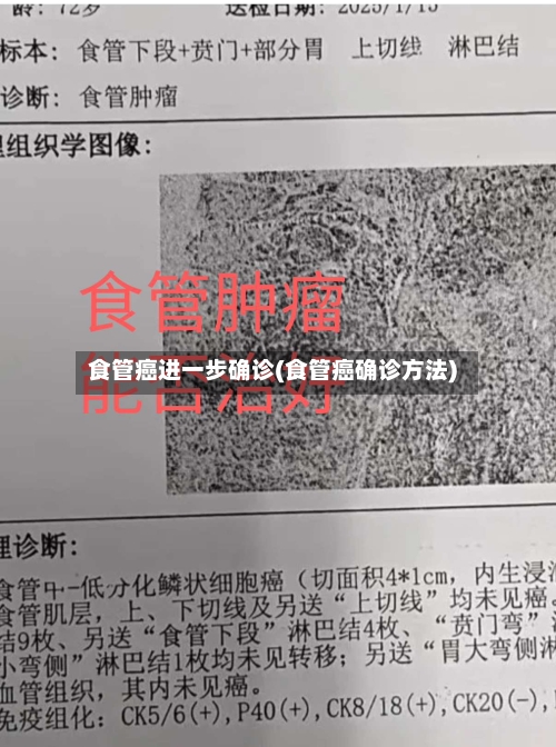 食管癌进一步确诊(食管癌确诊方法)-第2张图片