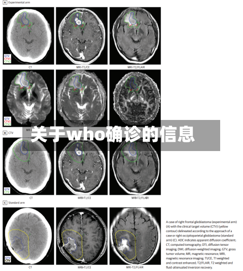 关于who确诊的信息-第3张图片